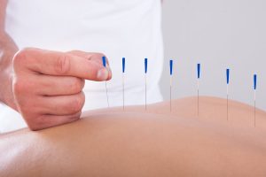طب سوزنی در منزل