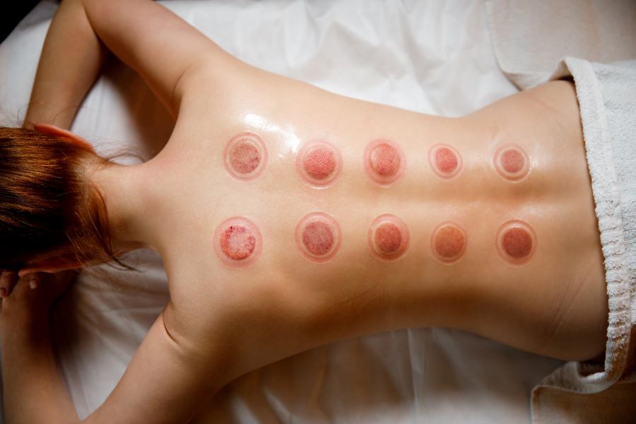 فصد خون بهتر است یا حجامت