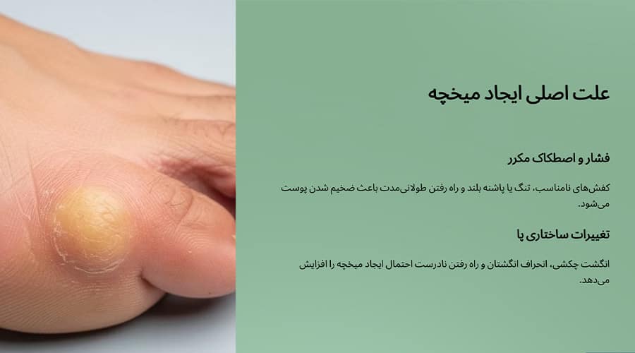 علت میخچه پا