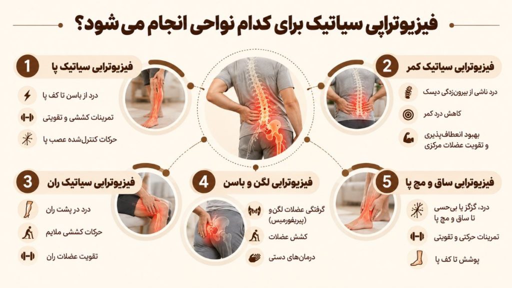 فیزیوتراپی سیاتیک برای کدام نواحی انجام می شود؟